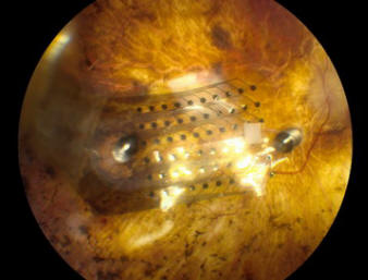 „argus-II-retinal-implant-640x538”